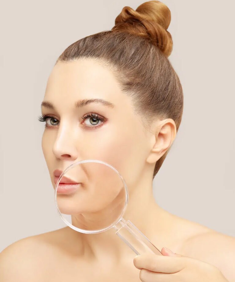 Nasolabial Filler in Fethiye